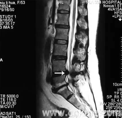 椎間盤病變 椎間盤病變