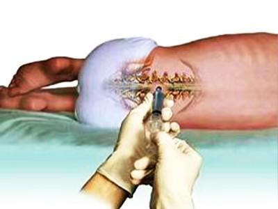 腰椎手術(shù)治療 腰椎手術(shù)治療