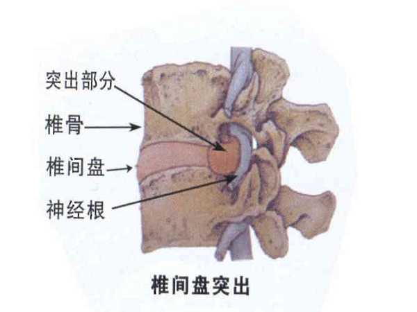 椎間盤突出 椎間盤突出