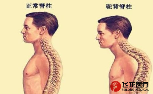 脊柱健康，不向生活“低頭”