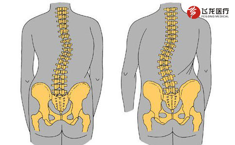 脊柱側(cè)彎 脊柱側(cè)彎