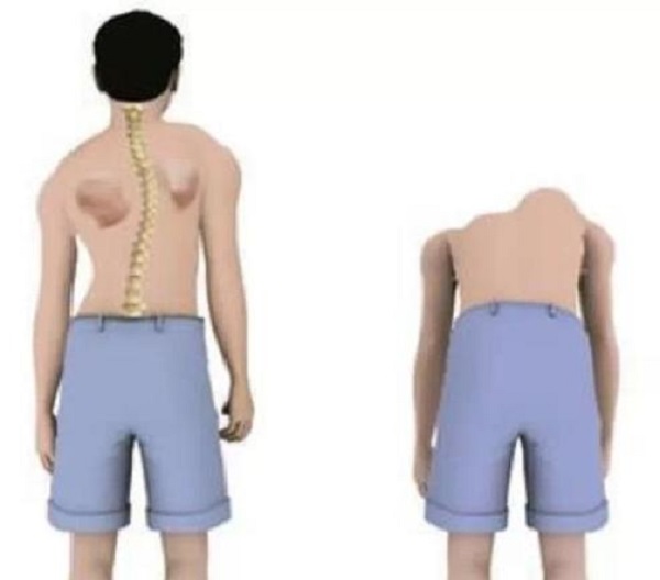 脊柱康復(fù) 脊柱康復(fù)