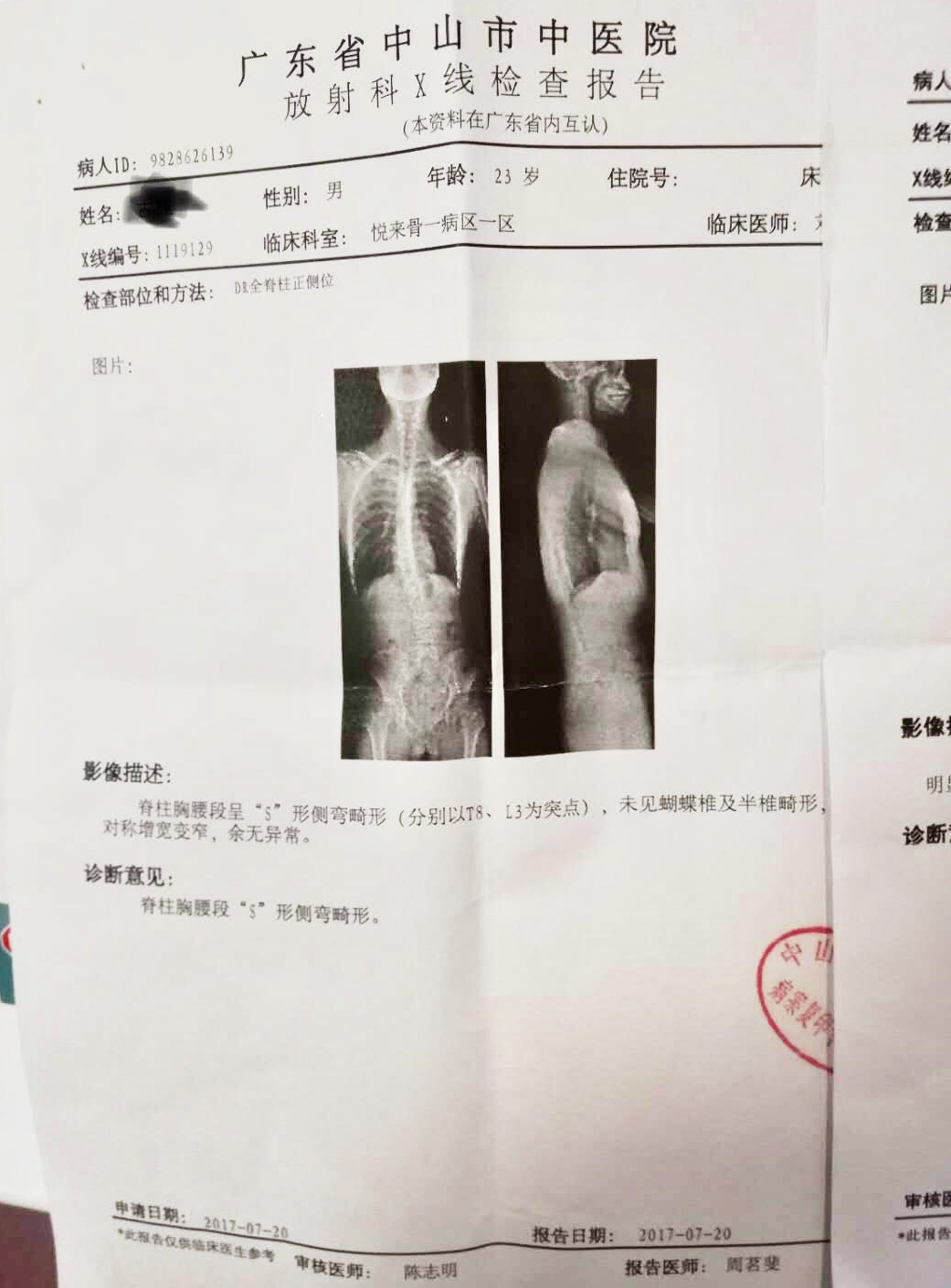 脊柱側(cè)彎X光檢查 脊柱側(cè)彎X光檢查