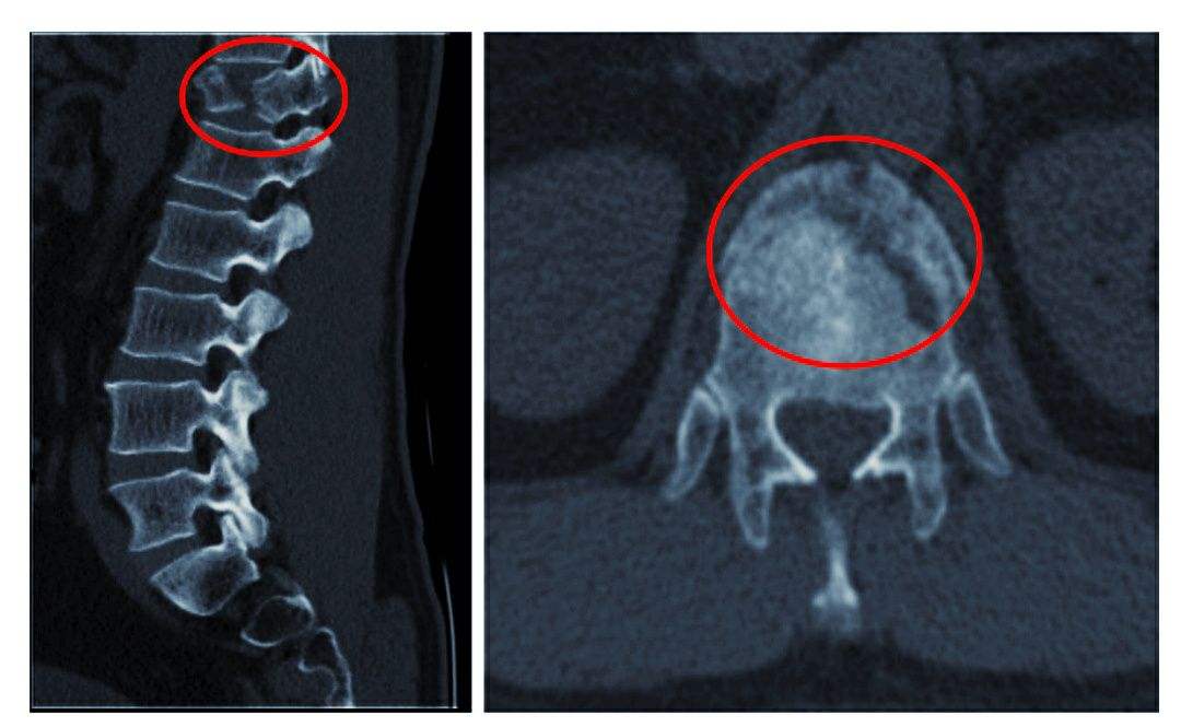 頸椎骨折 頸椎骨折