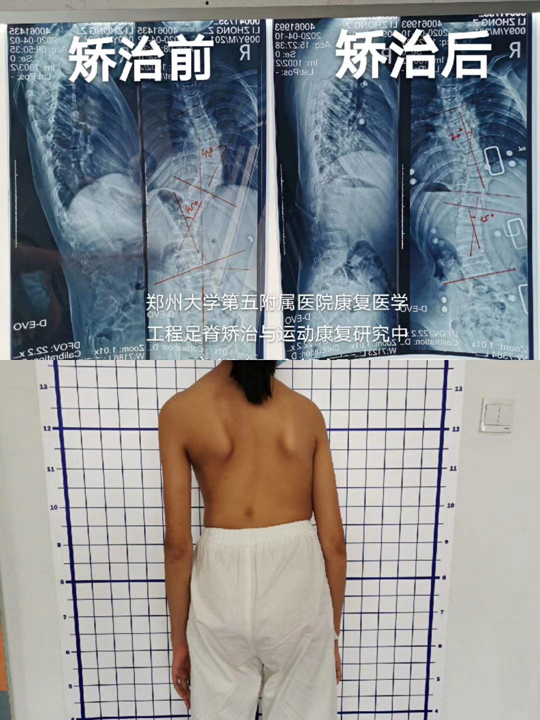 脊柱側彎治療 脊柱側彎治療