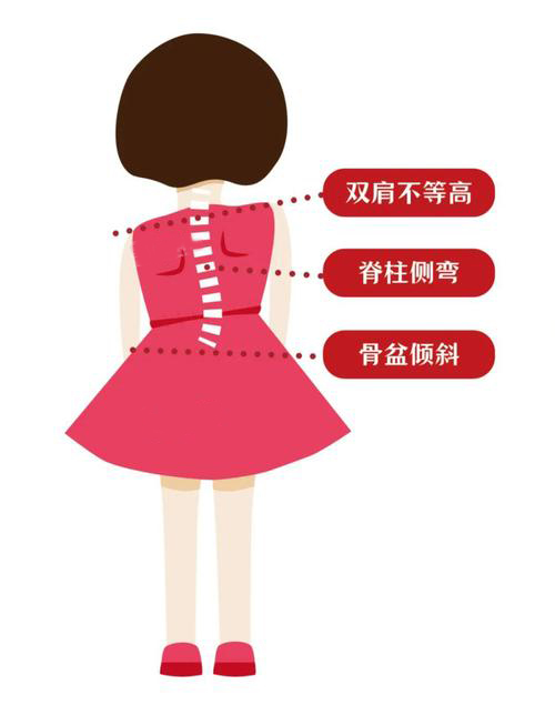 脊柱側(cè)彎彎曲異常 脊柱側(cè)彎彎曲異常